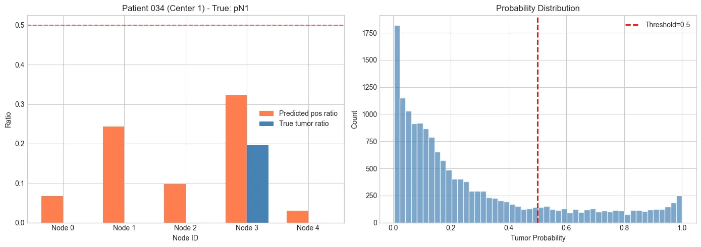 For patient 034 (center 1, true stage pN1), ratio of patches predicted positive for 5 nodes against the true tumor ratio, and histogram of tumor probabilities with the 0.5 threshold